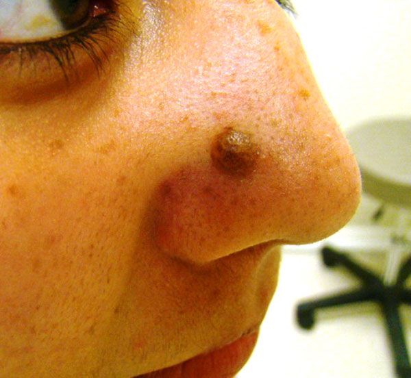 Close-up of a person's face showing a brown mole located on the side of the nose, with a blurred background of a medical office setting.