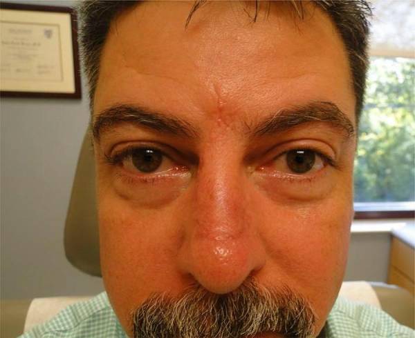 Close-up of a middle-aged man's face showing swelling and redness around both eyes, sitting indoors near a window.