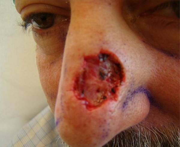 Close-up of a person's nose showing a large, open wound or ulcer on the tip, exposing raw tissue and surrounded by reddened skin.