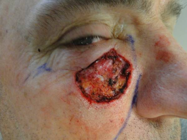 Close-up of a person's face showing a large, open wound with exposed tissue below the left eye, surrounded by redness and bruising. Blue surgical marking lines are visible on the skin.