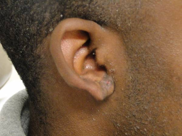 Close-up of the side of a person's head showing the ear with a raised, scar-like growth near the earlobe.