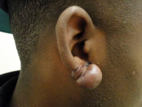 Close-up of a person's ear with a large keloid growth on the earlobe, partially marked with ink, against a blurred background.