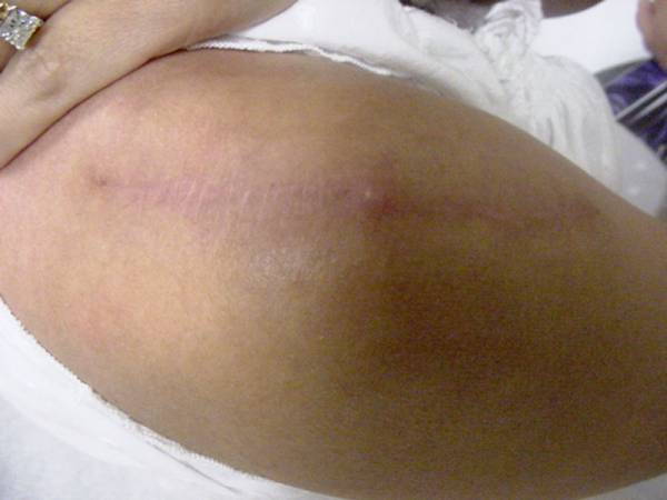 A close-up of a person's upper arm showing a healed, linear scar across the skin.