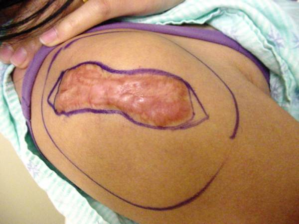 A raised, irregular scar surrounded by purple pen markings is visible on a person’s upper back or shoulder.