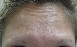 Botox After