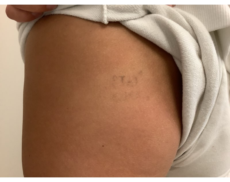 Tattoo after removal photo