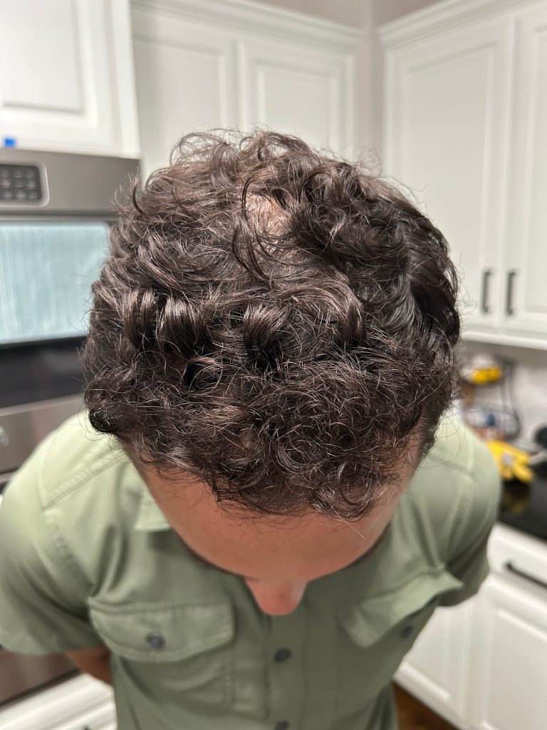 After Psoriasis Treatment