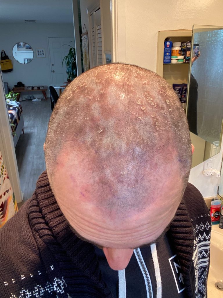 Before Psoriasis Treatment