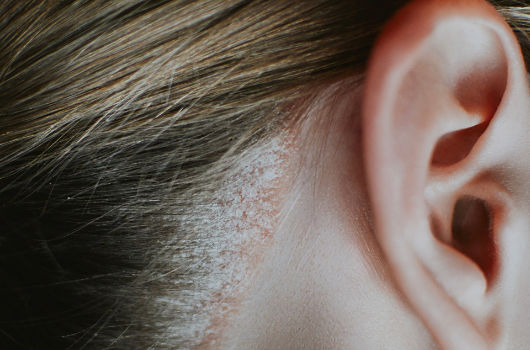 Psoriasis on a woman's head close-up with redness and peeling. High quality photo