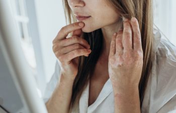 Sick person. Unrecognizable young woman suffering from autoimmune incurable dermatological skin disease called psoriasis. Large red inflamed scaly rash on elbows. joints affected by psoriatic arthriti